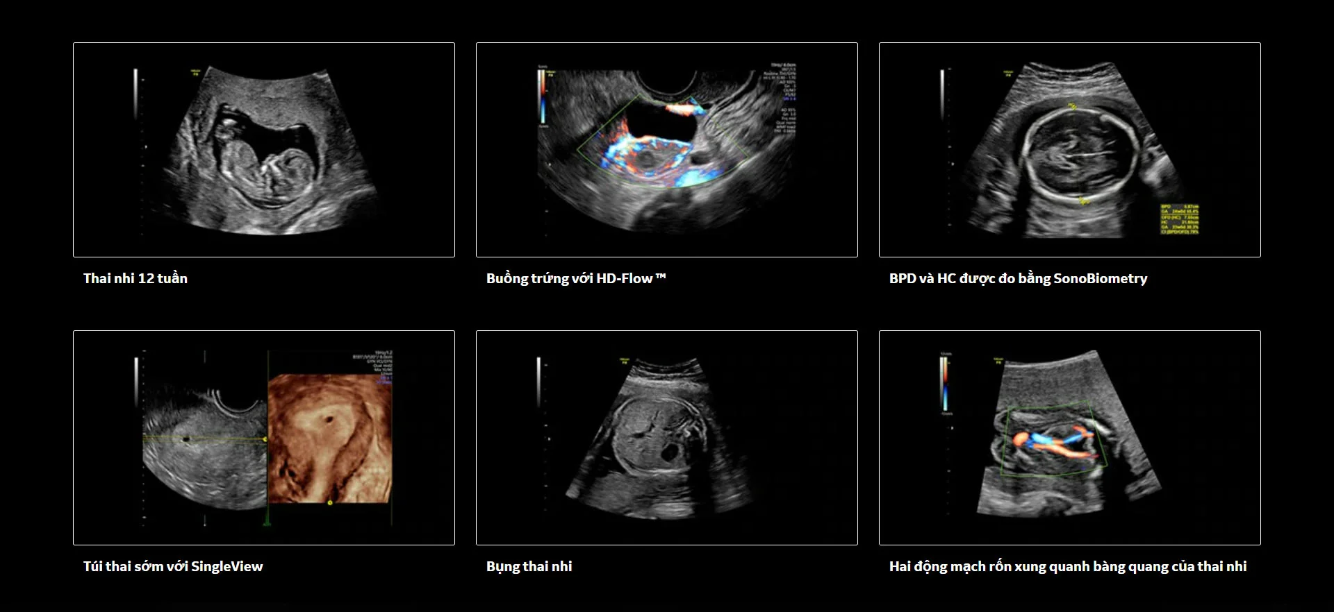 Siêu âm Voloson P8